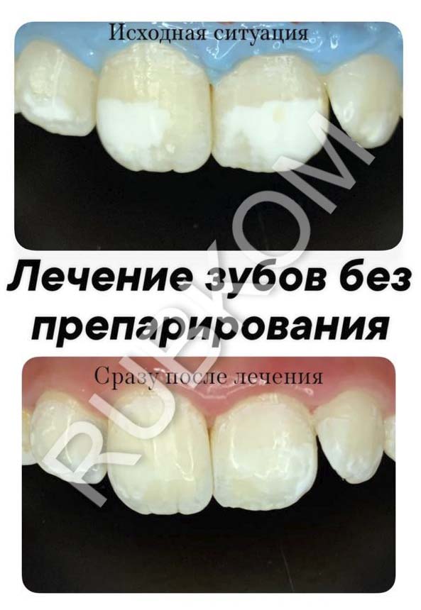 Лечение зубов в клинике на Войковской